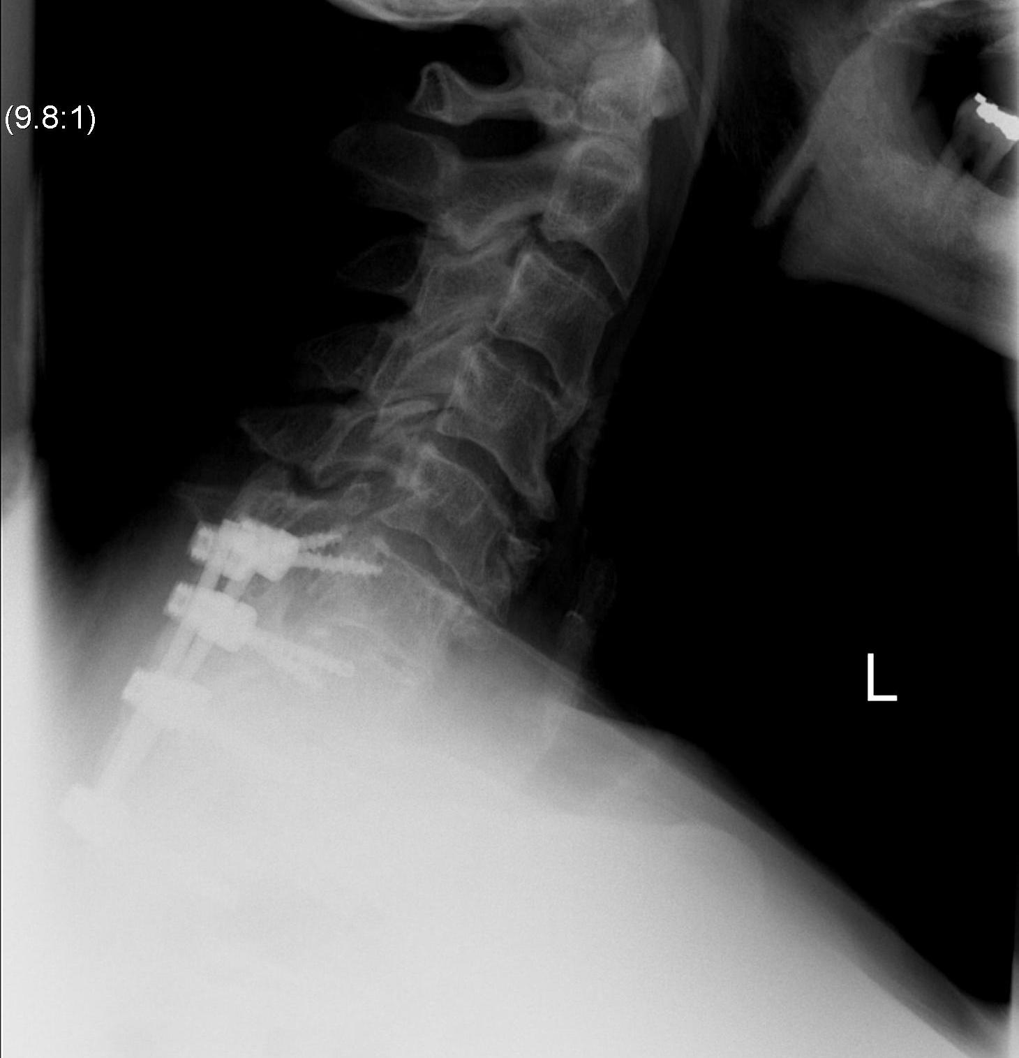 Cervical Spine Posterior Fusion for SAS